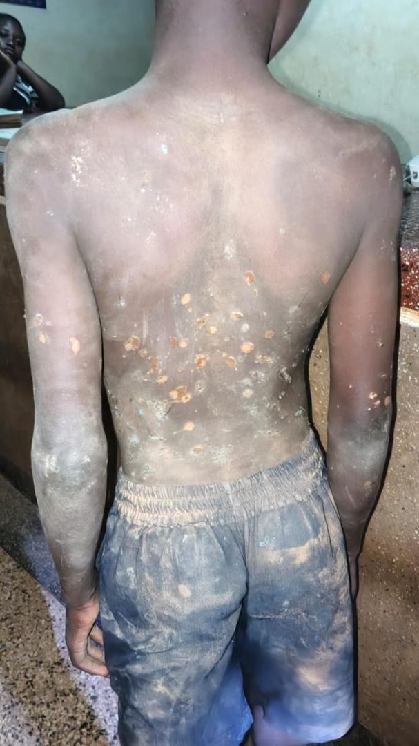 Amolatar RDC Orders Arrest of Couple for Torturing 10-Year-Old Son with Burning Jerrican